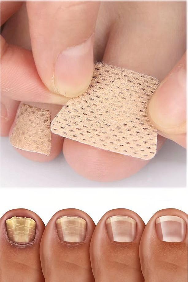 10 Çift Mantar Tırnak Yaması – Ayak ve El Tırnakları İçin Güçlü Mantar Tedavisi, Tırnak Yenileyici